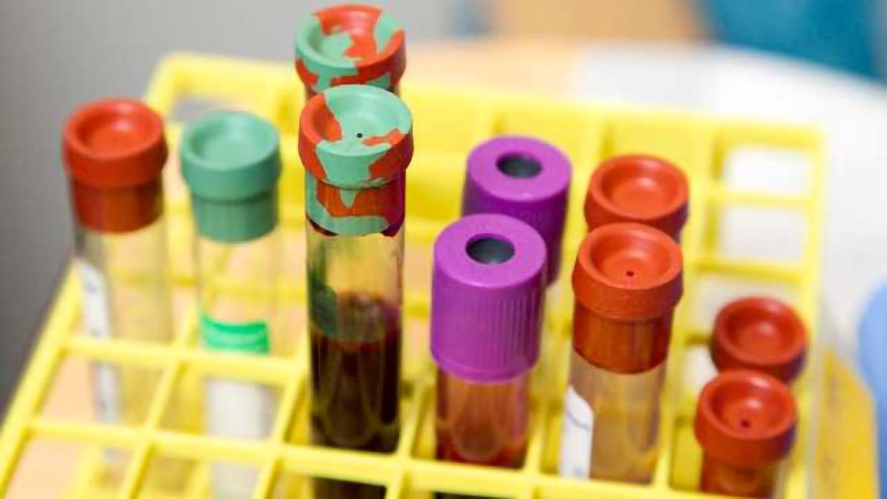 Simple Test to Predict Head & Neck Cancers' Likely Spread