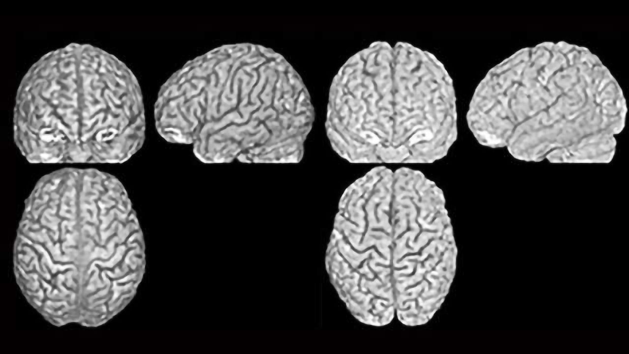 Brain Structure as Unique as a Fingerprint