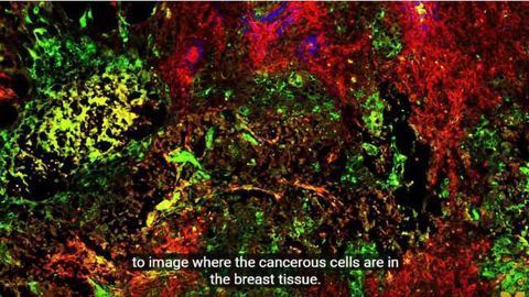 Pill for Better Diagnosis of Breast Cancer