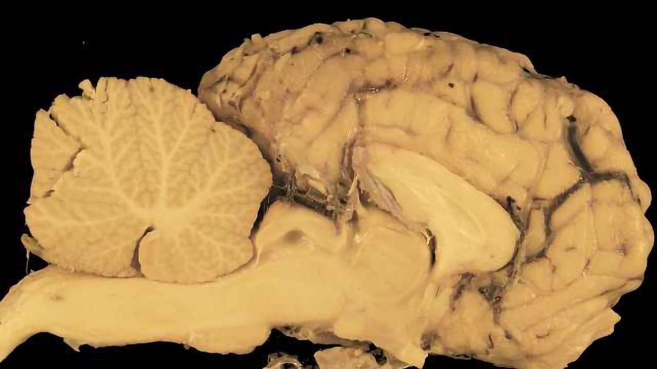 Autism Spectrum Disorder Linked to Shape of Brain's Cerebellum