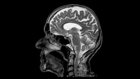 Machine Learning Helps Predict Schizophrenia Treatment Outcomes