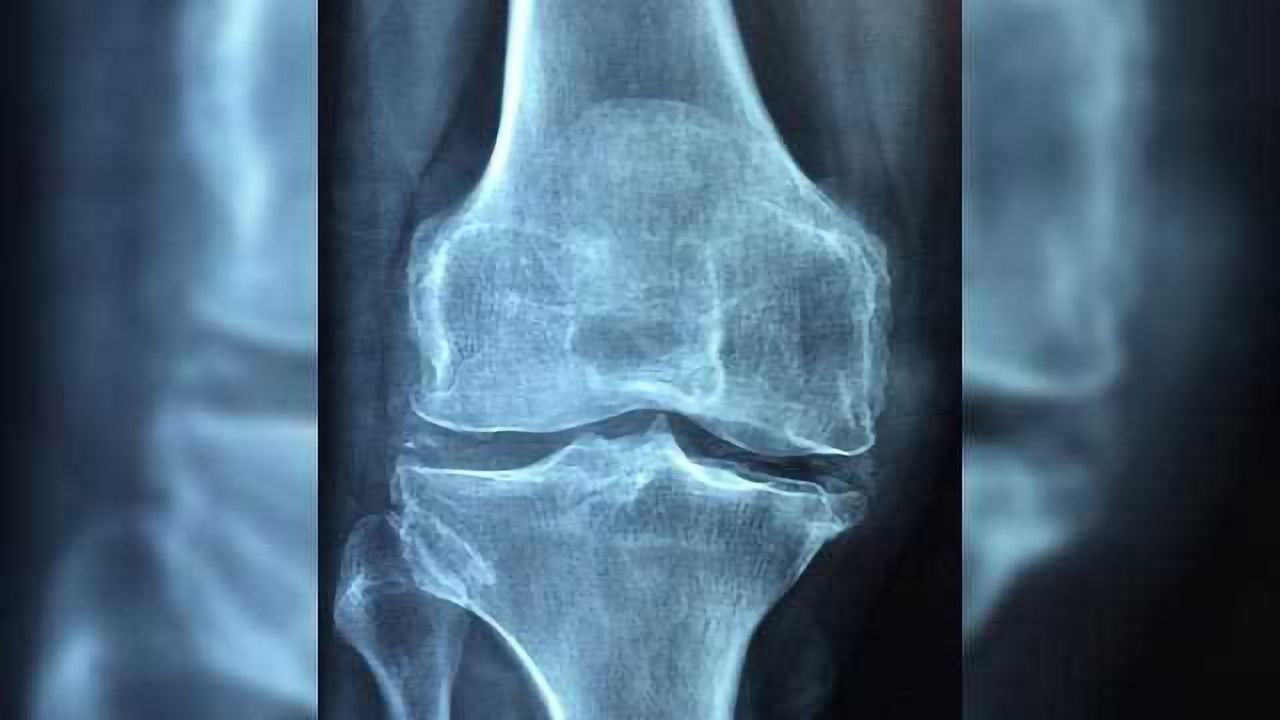Nano and Micro Join Forces to Treat Osteoarthritis