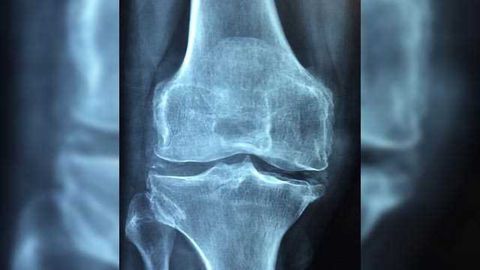 Nano and Micro Join Forces to Treat Osteoarthritis