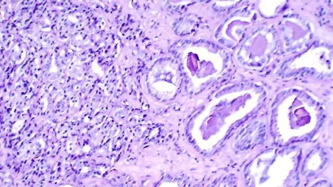 $26.5M Study on Aggressive Prostate Cancer in African-American Men Begins