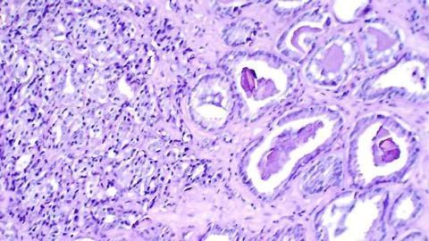$26.5M Study on Aggressive Prostate Cancer in African-American Men Begins
