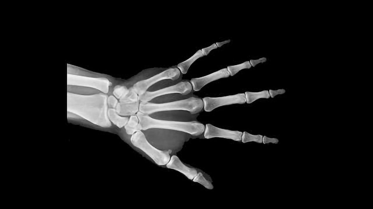 Regenerative Medicine Meets Clever Engineering to Accommodate Bone Grafts