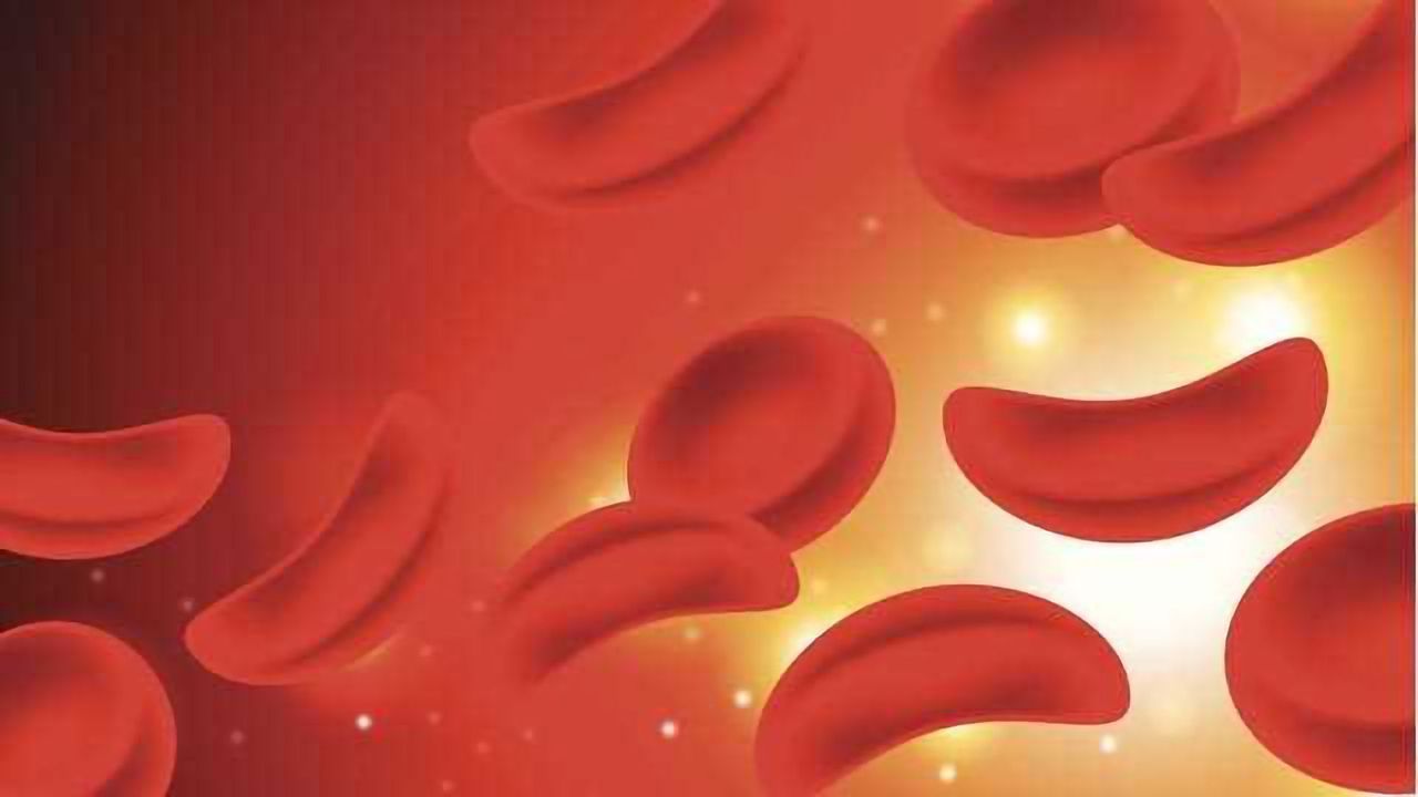 CRISPR Screening Reveals Drug Target for Sickle Cell Disease