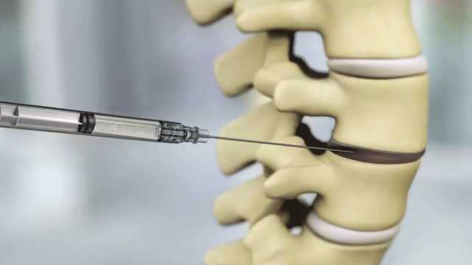 Injectable Discogenic Cell Therapy Developed to Alleviate Back Pain content piece image