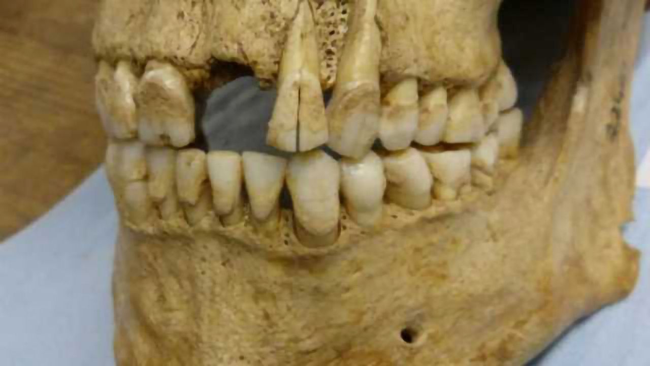 Bad Teeth Put to Good Use