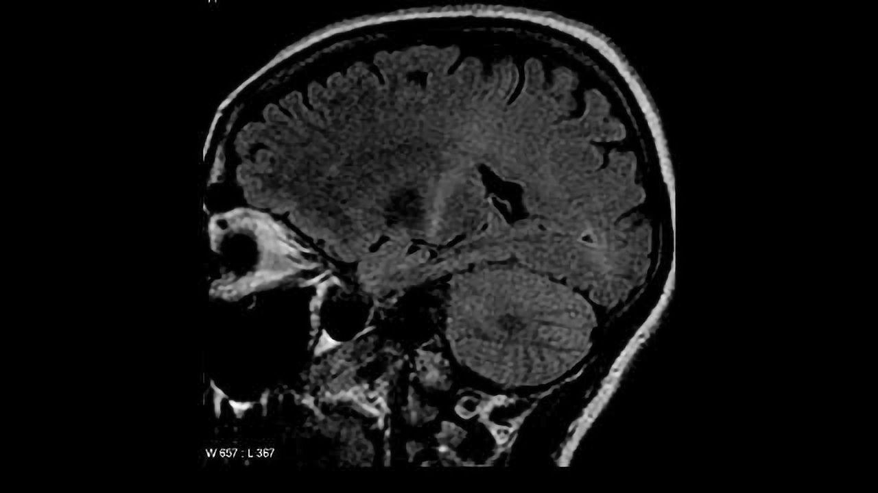 What Makes Good Brain Proteins Turn Bad?