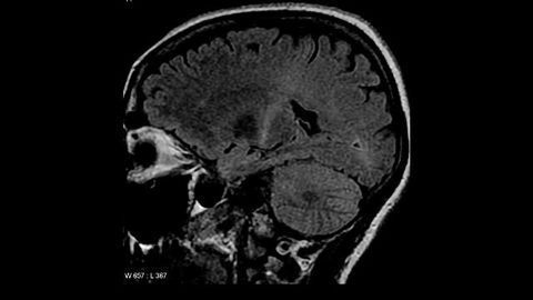 What Makes Good Brain Proteins Turn Bad?