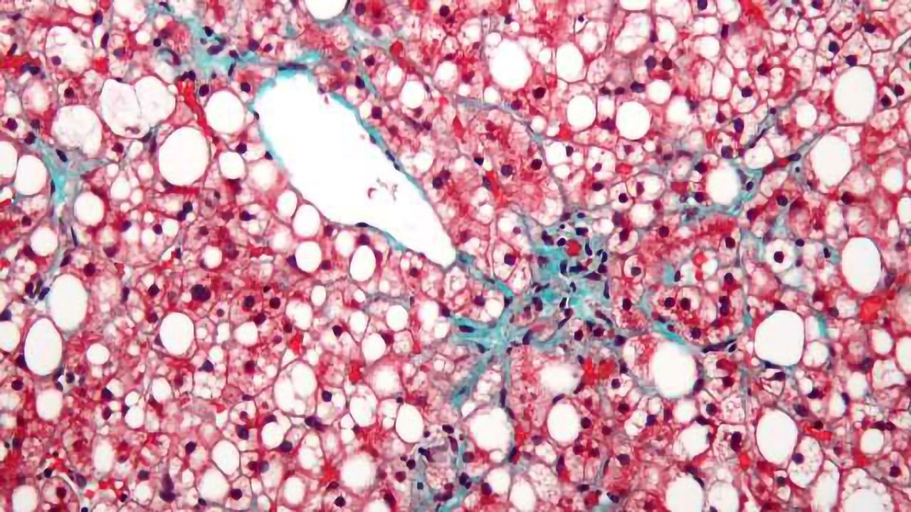 Scientists Track Down Genes Associated with Liver Disease
