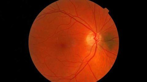Thinner Retinas are Early Sign of Cognitive Decline
