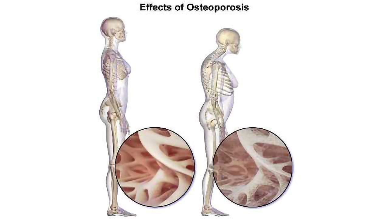 Genetic Screen Predicts Osteoporosis Risk