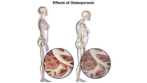 Genetic Screen Predicts Osteoporosis Risk
