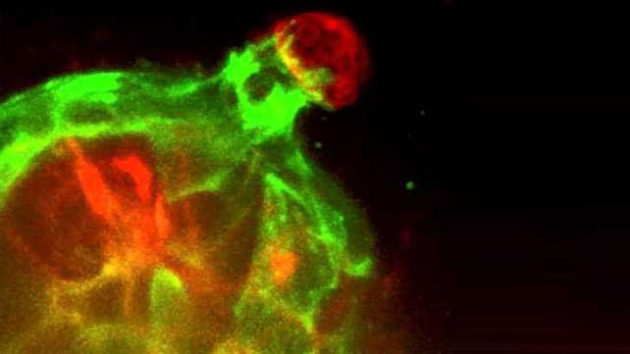 Dynamic Cellular Defense Against Breast Cancer Invasion