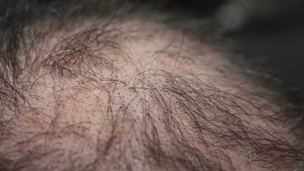 Hair Loss and Skin Damage Reversal from Experimental Drug