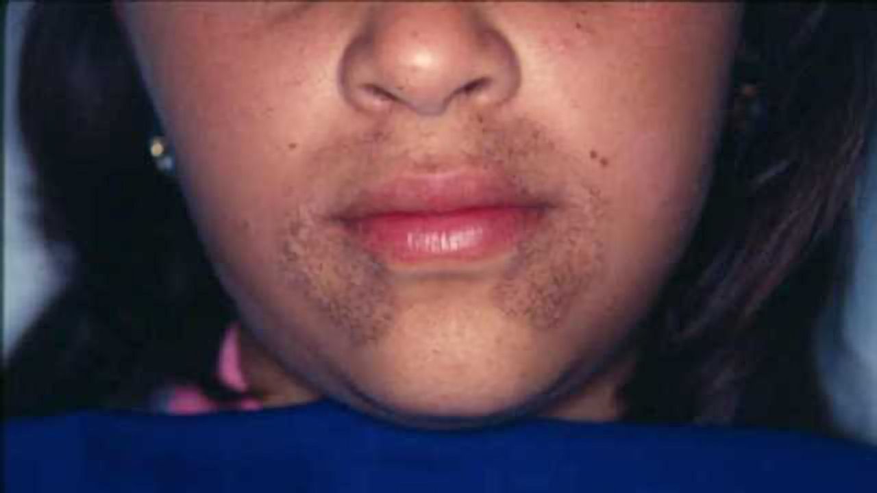 A Treatment for Ultra-Rare Black Bone Disease has Been Developed