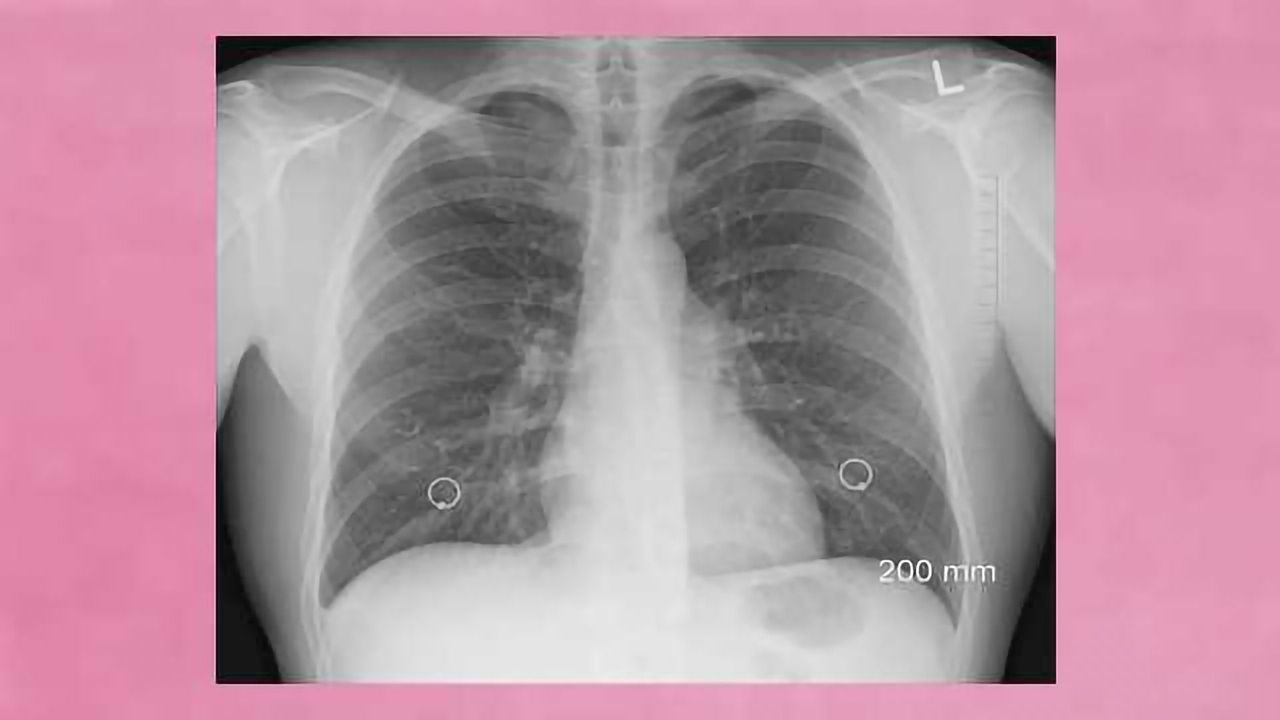 Bioengineered Lungs Successfully Transplanted into Pigs
