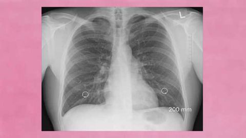 Bioengineered Lungs Successfully Transplanted into Pigs