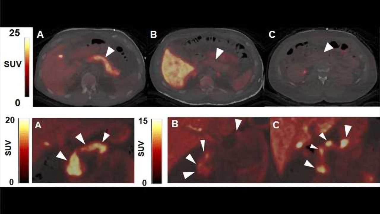 A PET Imaging Method to Track and Guide Diabetes Therapies