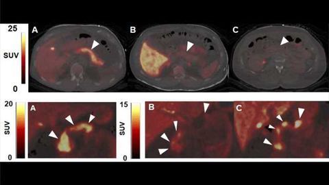 A PET Imaging Method to Track and Guide Diabetes Therapies