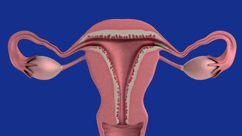 Women with Polycystic Ovary Syndrome More Likely to Have a Child with Autism