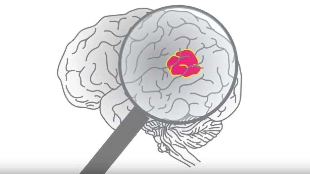 Targeted Approach to Treating Glioma
