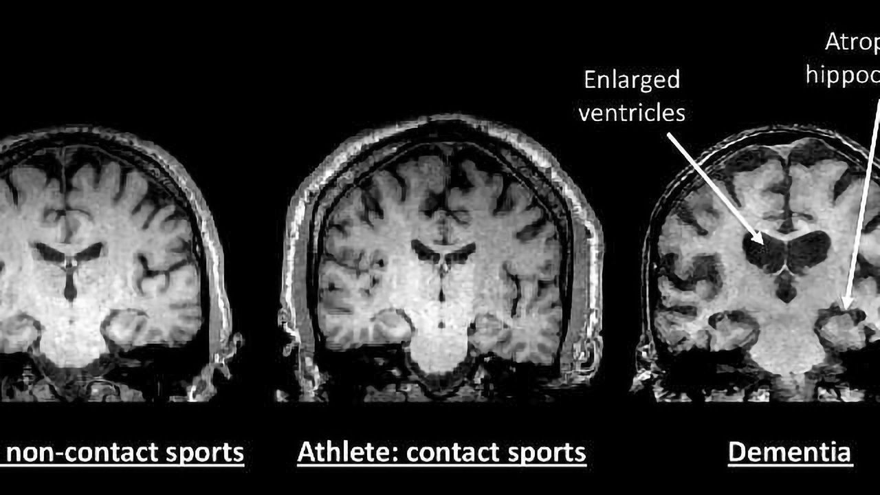 Comprehensive Study of 21 Retired NFL and NHL Players Doesn’t Find Evidence of Early Onset Dementia