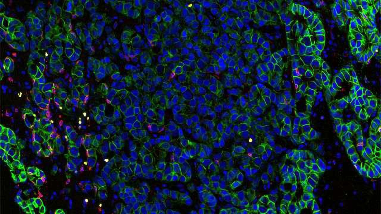 New Prostate Cancer Blood Test Detects Early Treatment Failure