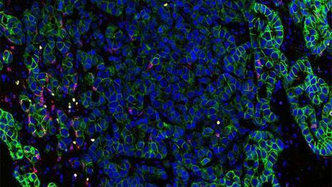 New Prostate Cancer Blood Test Detects Early Treatment Failure