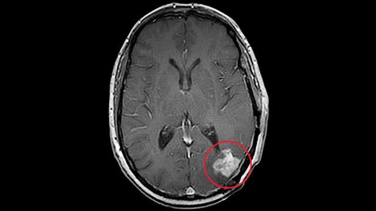Hunt for the Missing T-Cells in Glioblastoma Patients