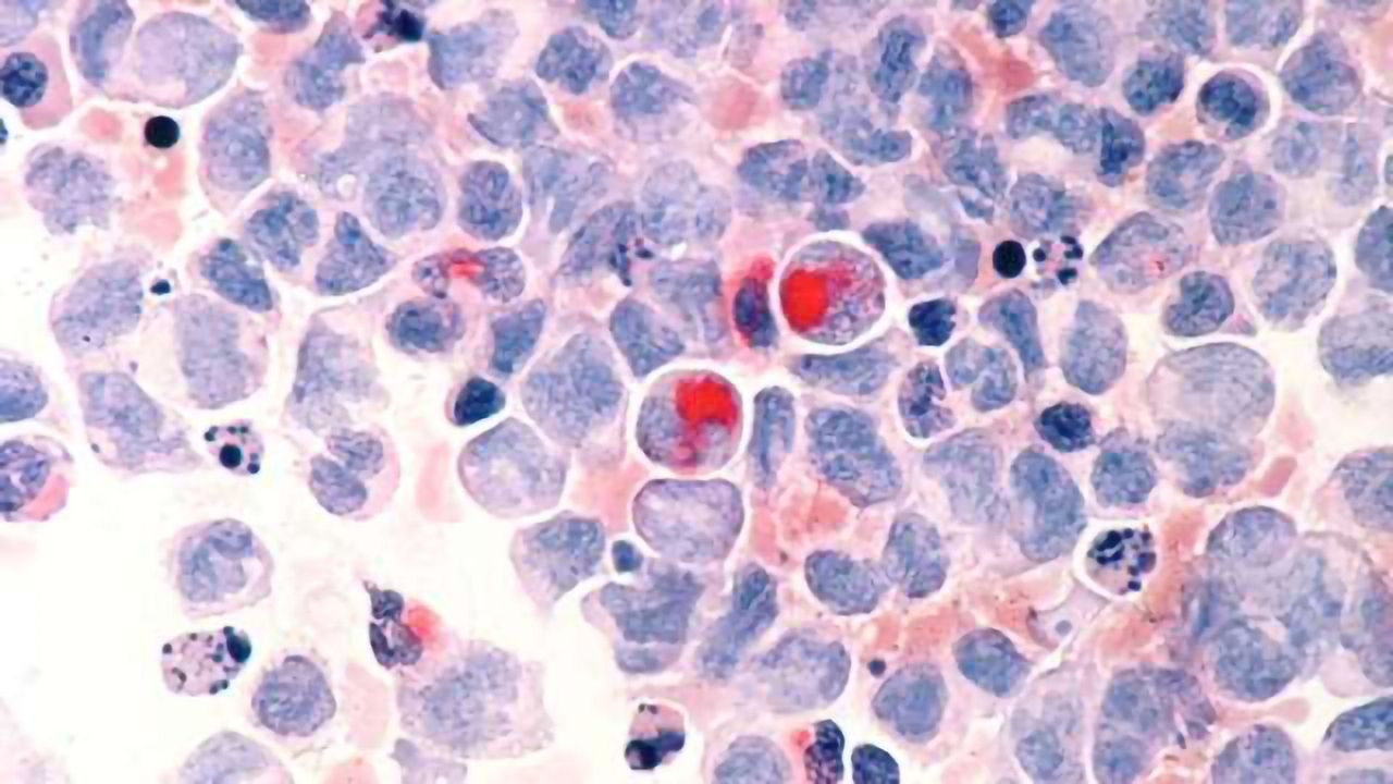Major New Vulnerability of Childhood Leukemia Uncovered