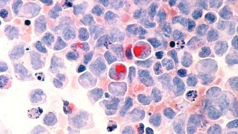 Major New Vulnerability of Childhood Leukemia Uncovered