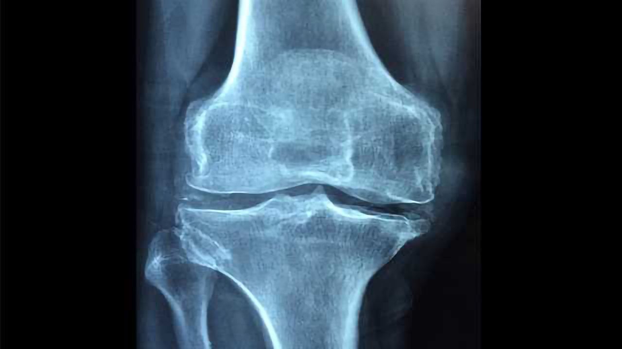 Platelet-Rich Plasma Does Not Promote Stem Cell-Mediated Cartilage Repair