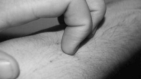 Scrap the Scratching: New Way to Treat an Itch