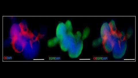 Circulating Tumor Cell Clusters Identified in Head and Neck Cancer Patients