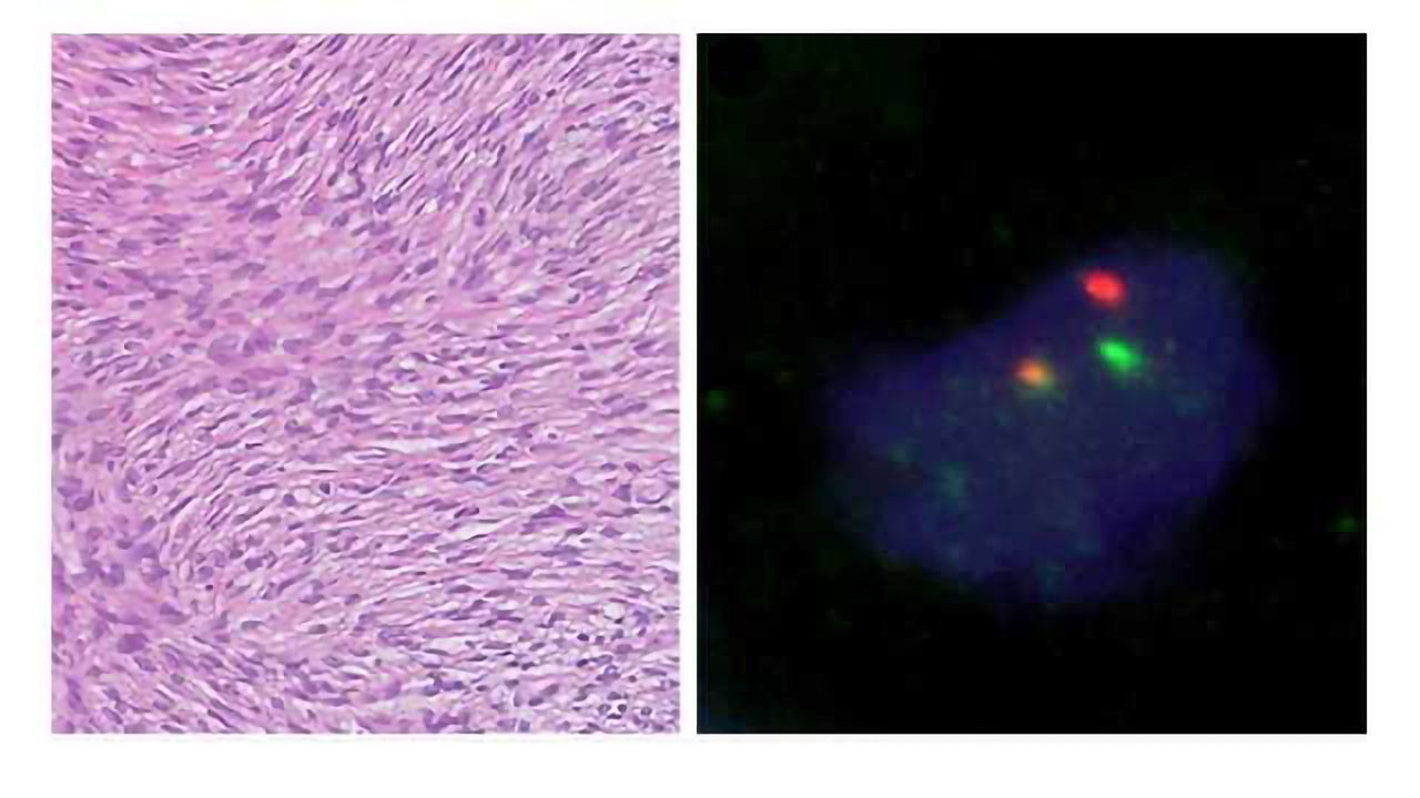 PCR Assay Helps ID Sarcoma Mutations