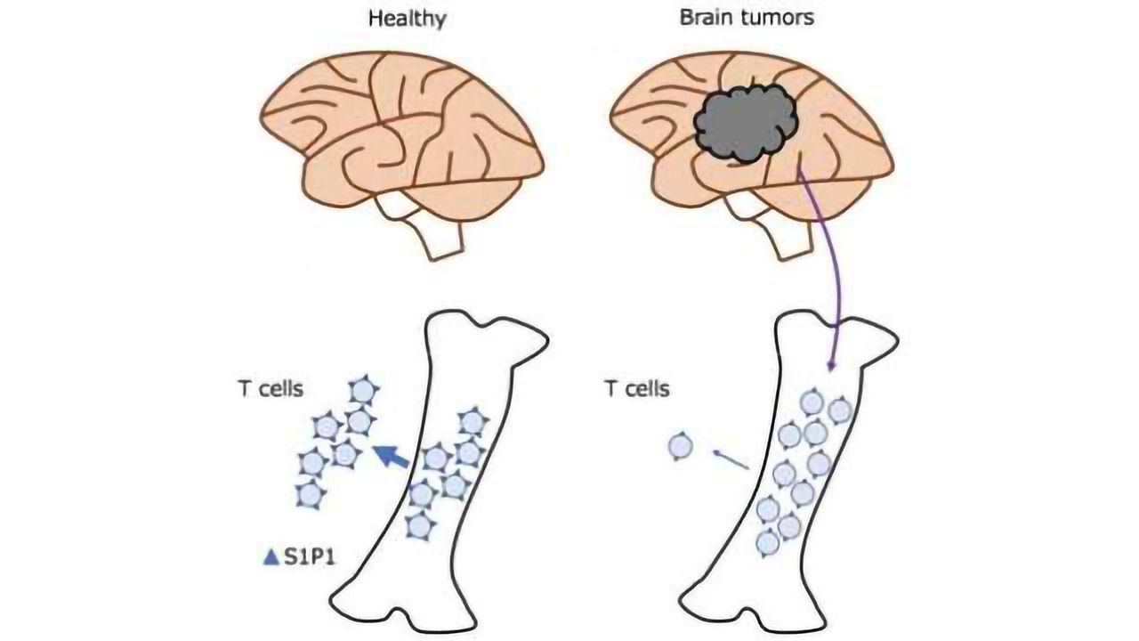 Brain Cancer Potentially Resists Immunotherapies by Trapping T Cells in Bone Marrow