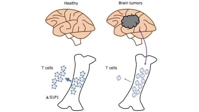 脑癌可能抵抗免疫疗法把T细胞在骨髓图像内容块