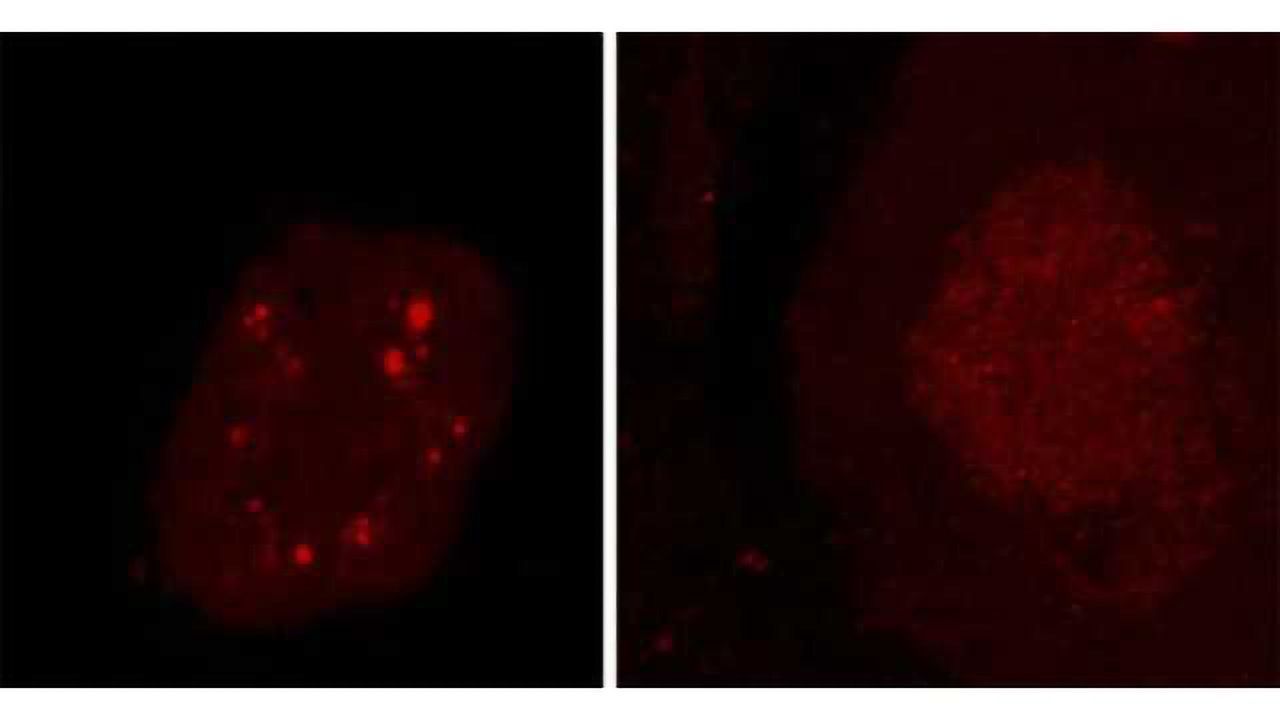 Common Disease Mechanism for ALS and Frontotemporal Dementia