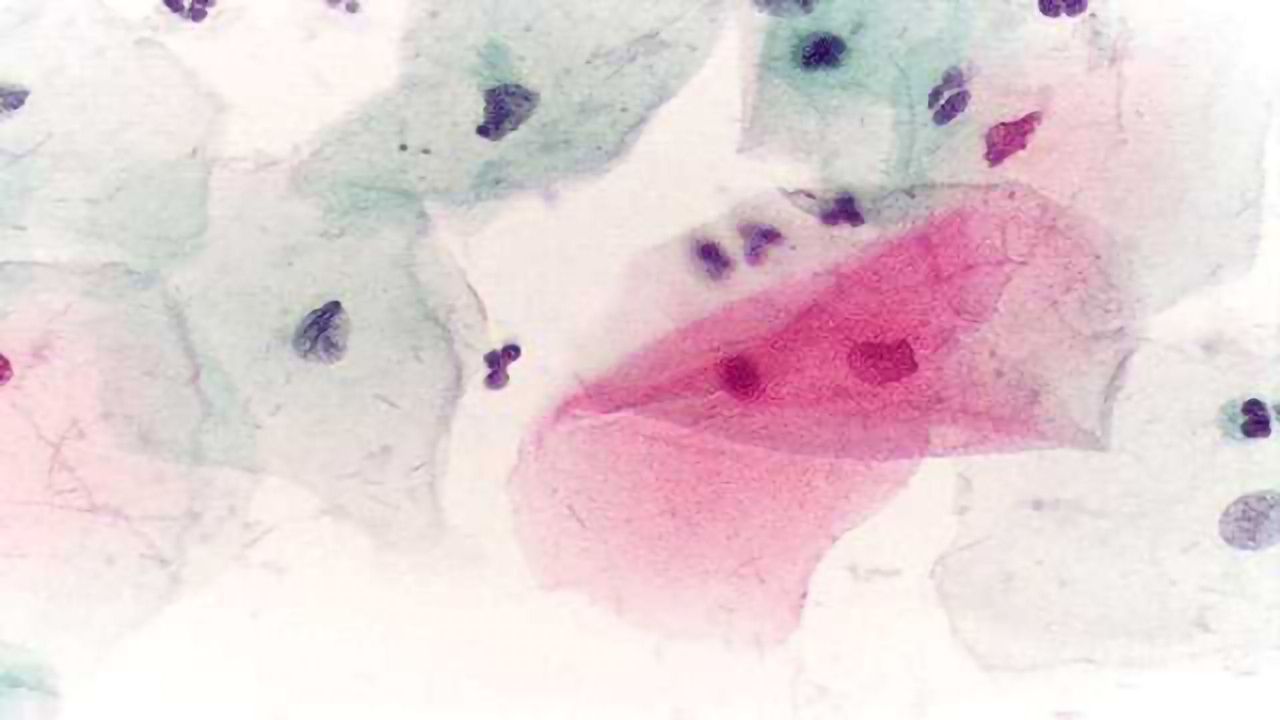 Pap Smear Frequency Recommendations Updated in USA