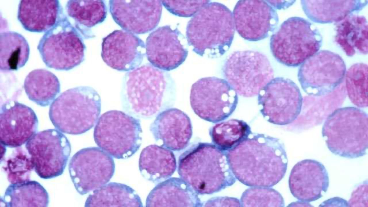 Drug Takes Aim at Cancers Associated with Epstein-Barr Virus