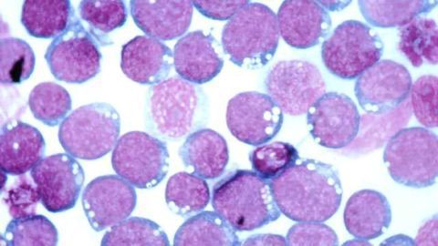 Drug Takes Aim at Cancers Associated with Epstein-Barr Virus