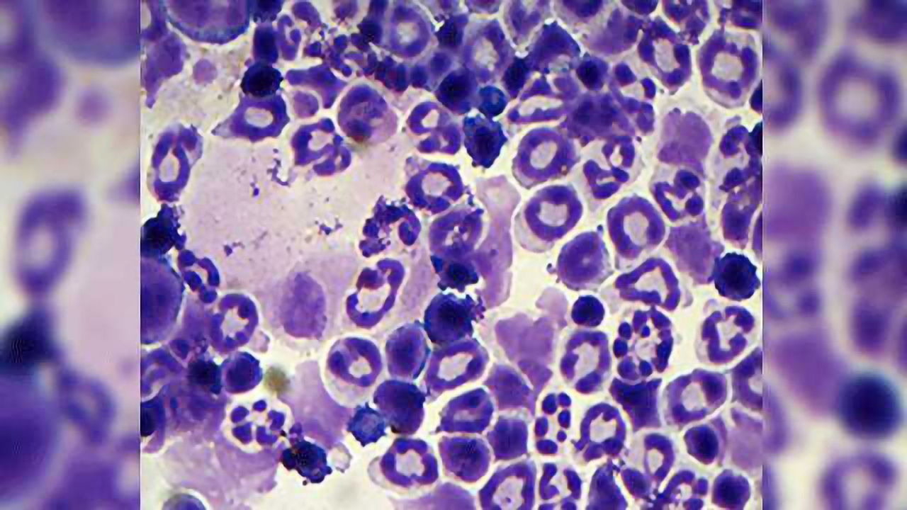 Dysregulated HIF1A Gene Responsible for Some Bone Marrow Disorders