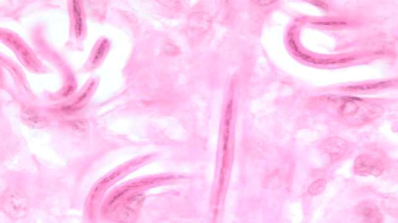 New Urine Dipstick Test Detects Disease Source That Blinds Millions