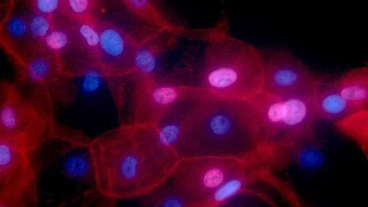 Some Breast Cancer Tumors Can Stop Their Own Spread