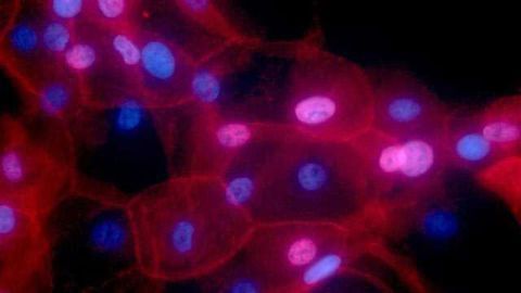 Some Breast Cancer Tumors Can Stop Their Own Spread