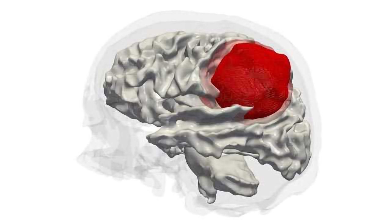 Epigenetic Analysis of Aggressive Brain Tumors