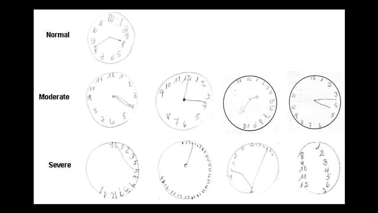 Researchers Assess Usefulness of Clock Drawing Cognitive Test in Patients with High Blood Pressure
